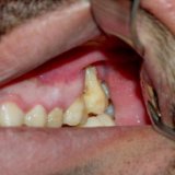Gencive abîmée par le snus. DR